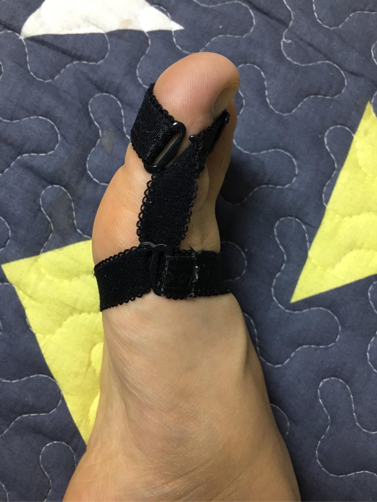 女生脚趾拇外翻是什么样体验? - 知乎