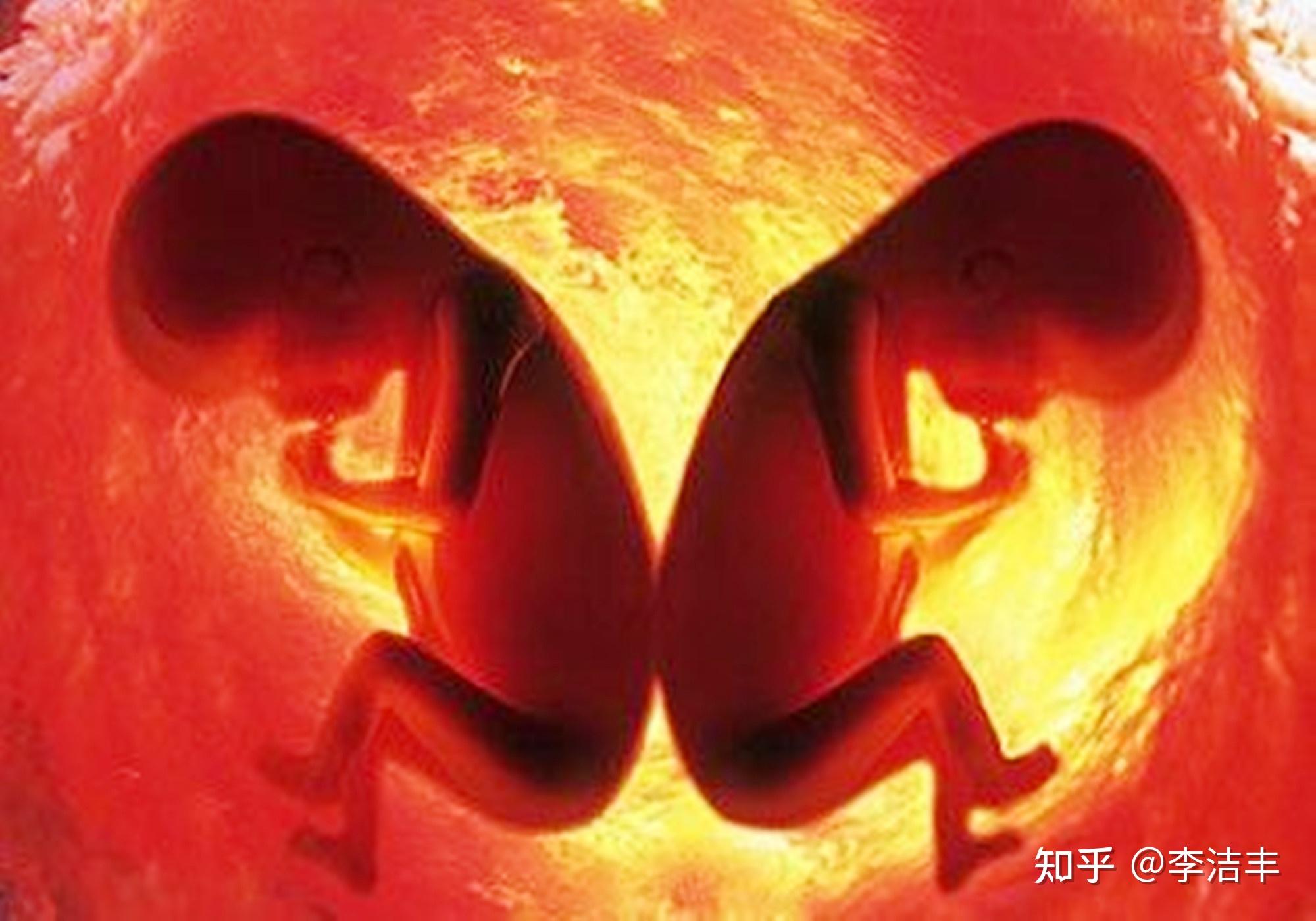 双胞胎是怎样形成的 双胞胎是怎样形成的?李少芬