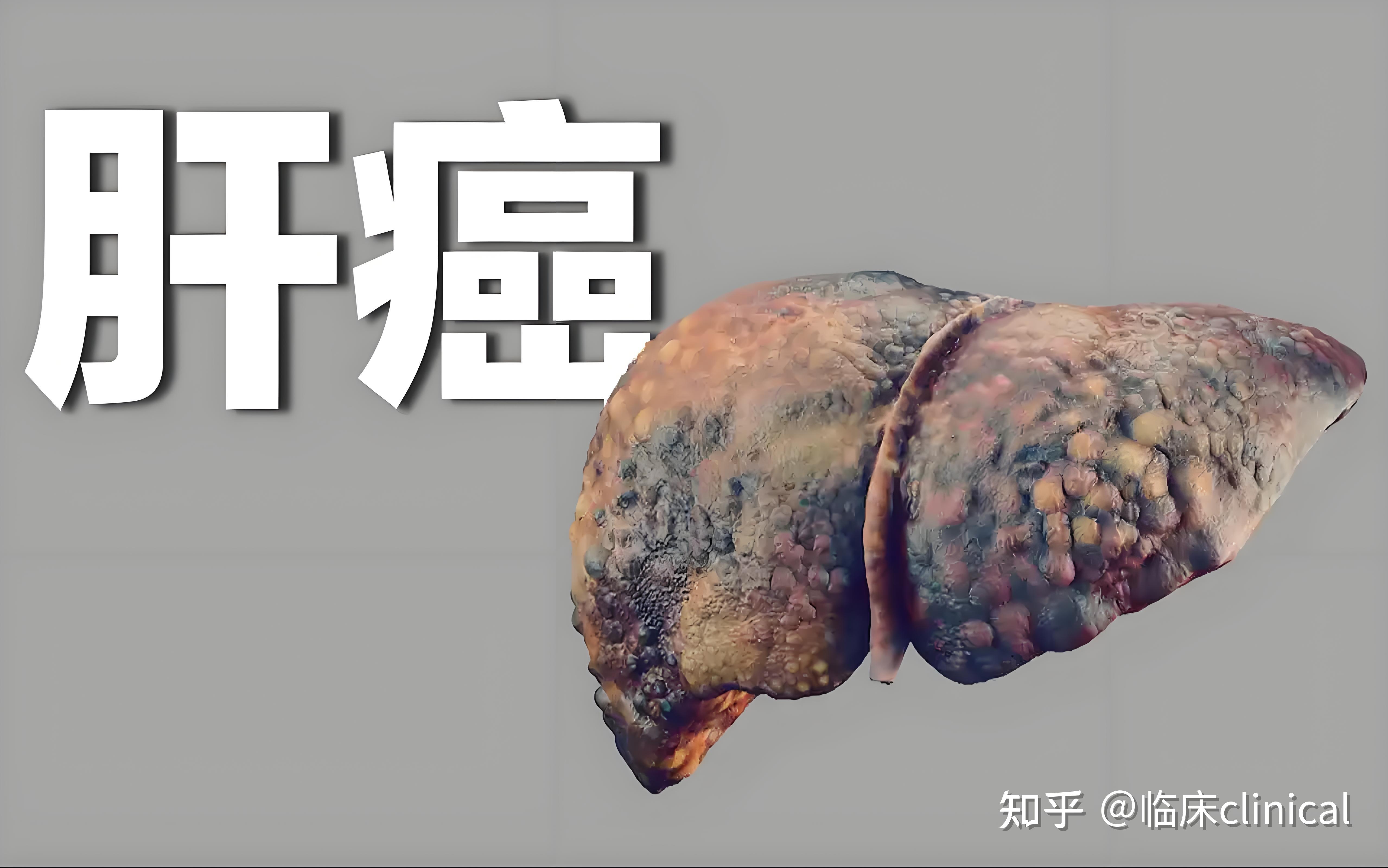 肝硬化是肝癌晚期吗