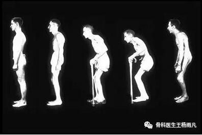 中青年男性腰背痛 足跟痛 关节疼 当心强直性脊柱炎 知乎