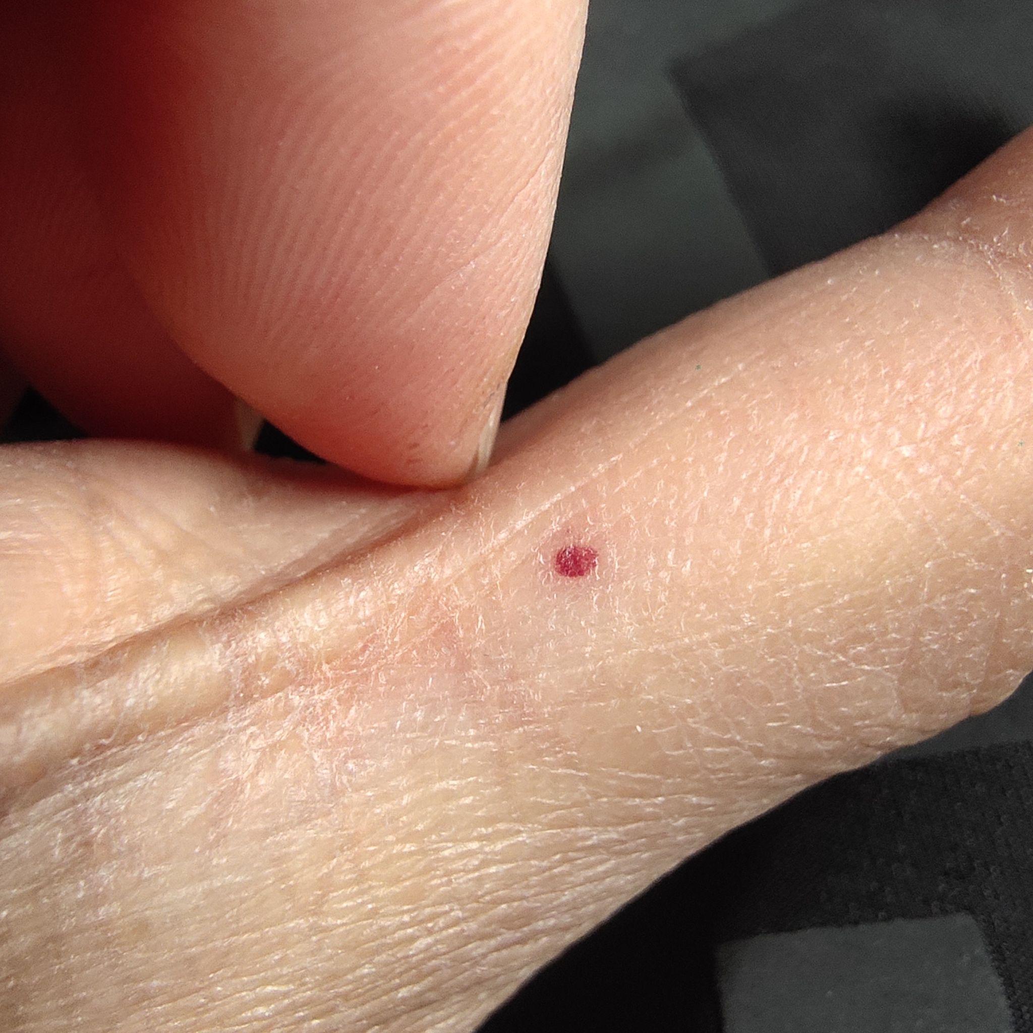 手指上长了一个针眼大的小红点 感觉像血管 一按就消失 松开就又出现