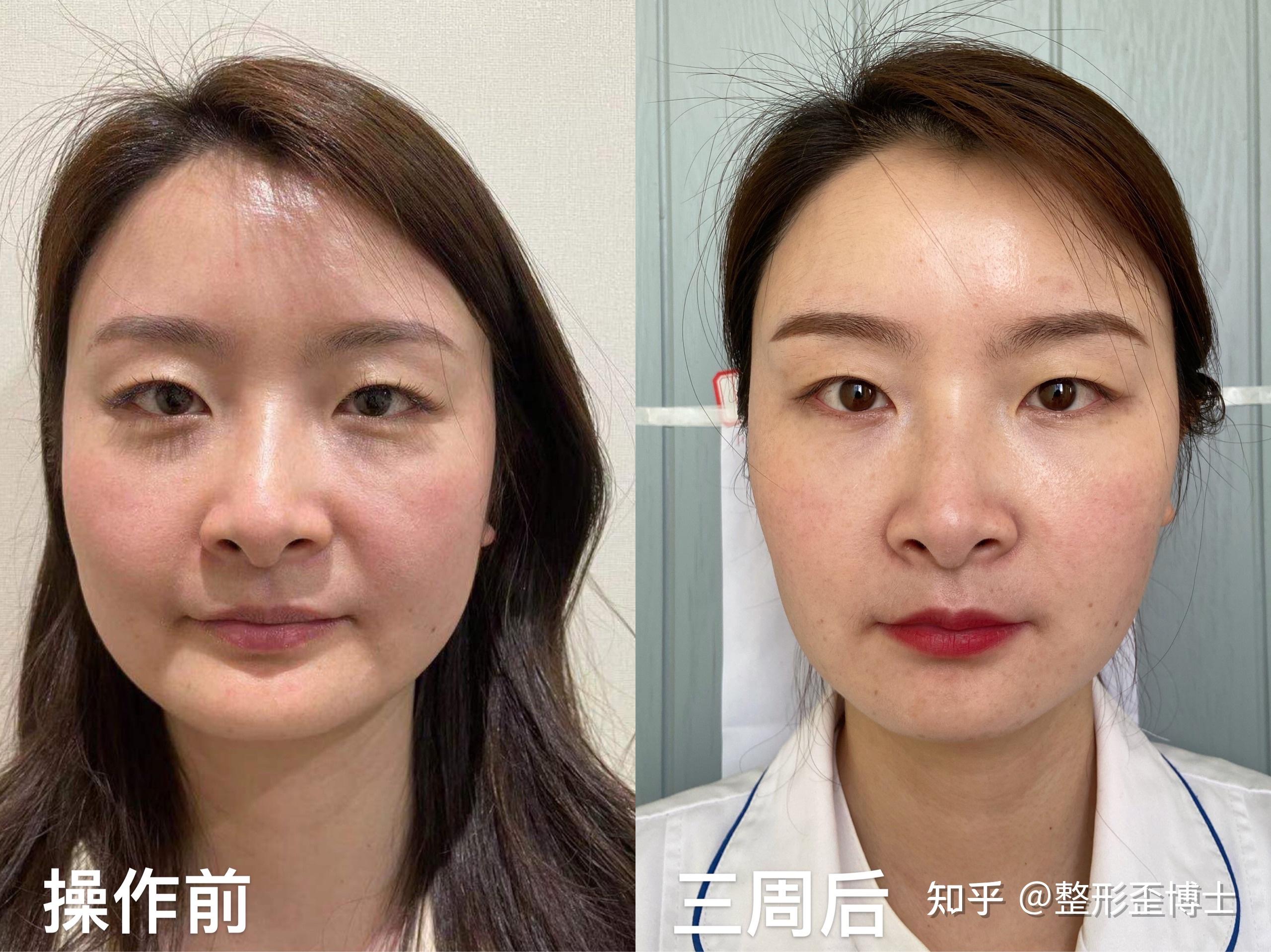 有没有去除法令纹的案例