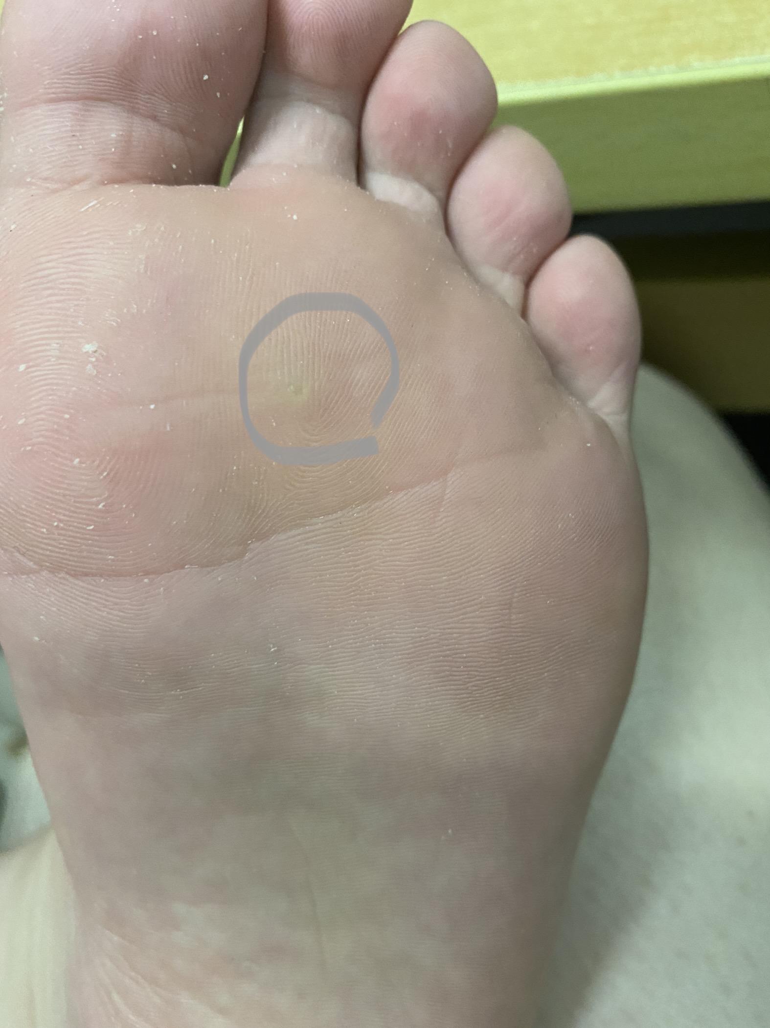 脚上长了鸡眼最好用什么方法可以治好呢