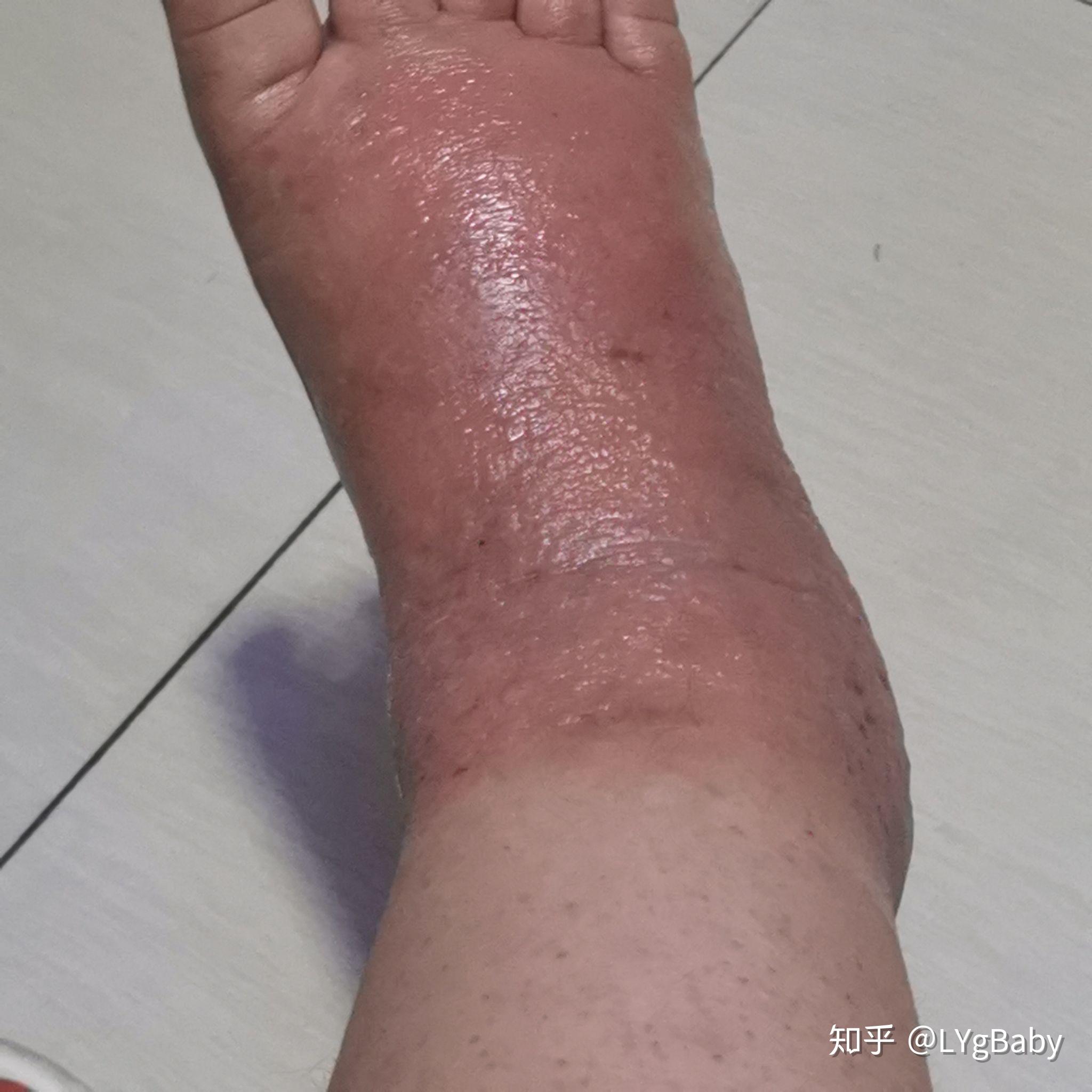 皮肤过敏起水泡怎么办? - 知乎