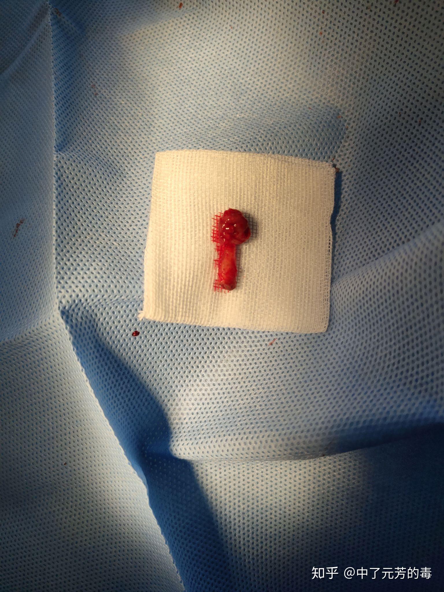 下颌骨囊肿,治疗方法和医院? - 知乎