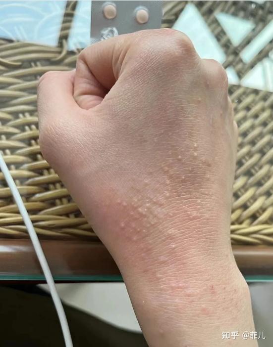 手背起湿疹有哪些比较好的治疗方法?