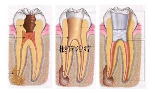 合肥根管治療牙齒多少錢