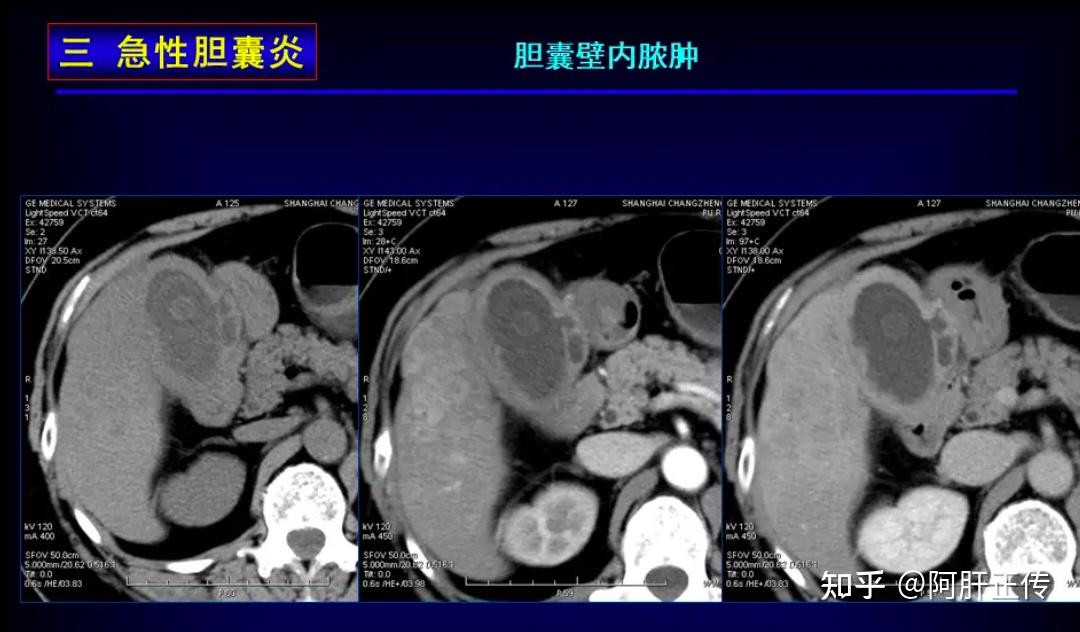 胆囊炎患者需要进行哪些检查? - 知乎