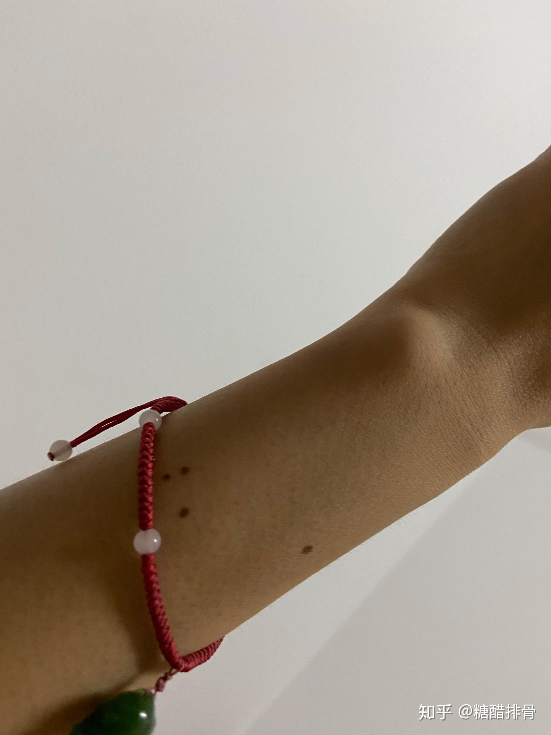 左臂上有三颗痣呈正三角形分布有什么含义