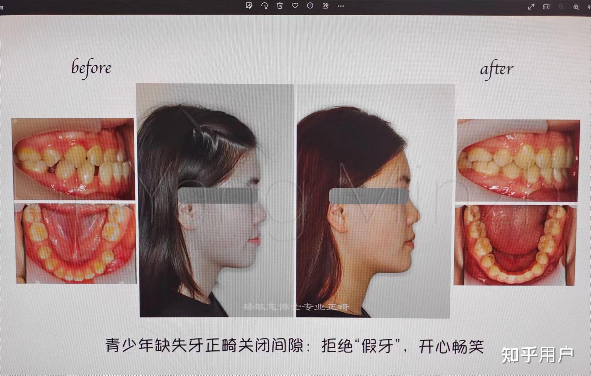 地包天矫正牙齿能改变脸型吗? - 知乎