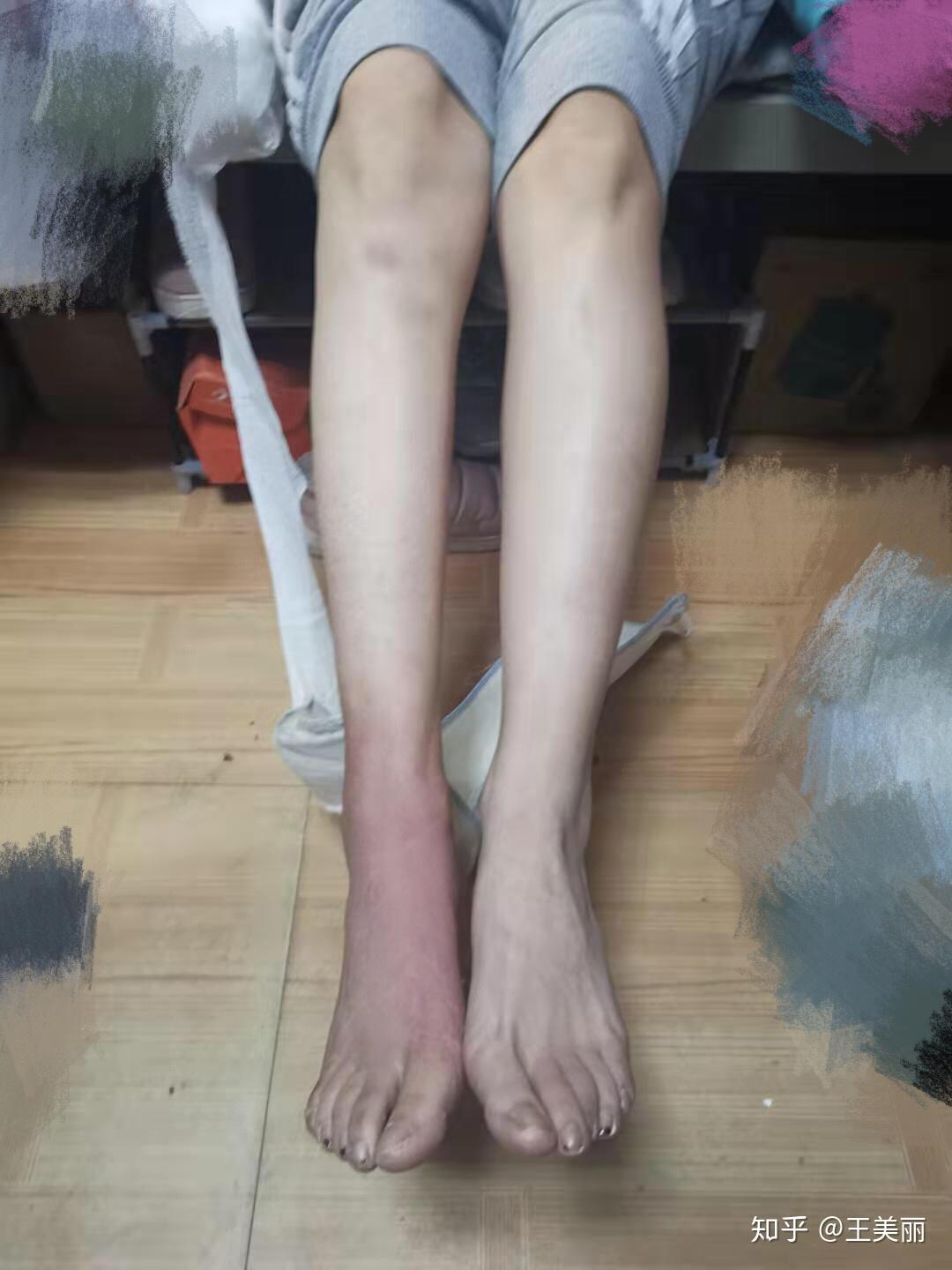 如何让左腿跟拆了石膏肌肉萎缩的右腿一样瘦? 