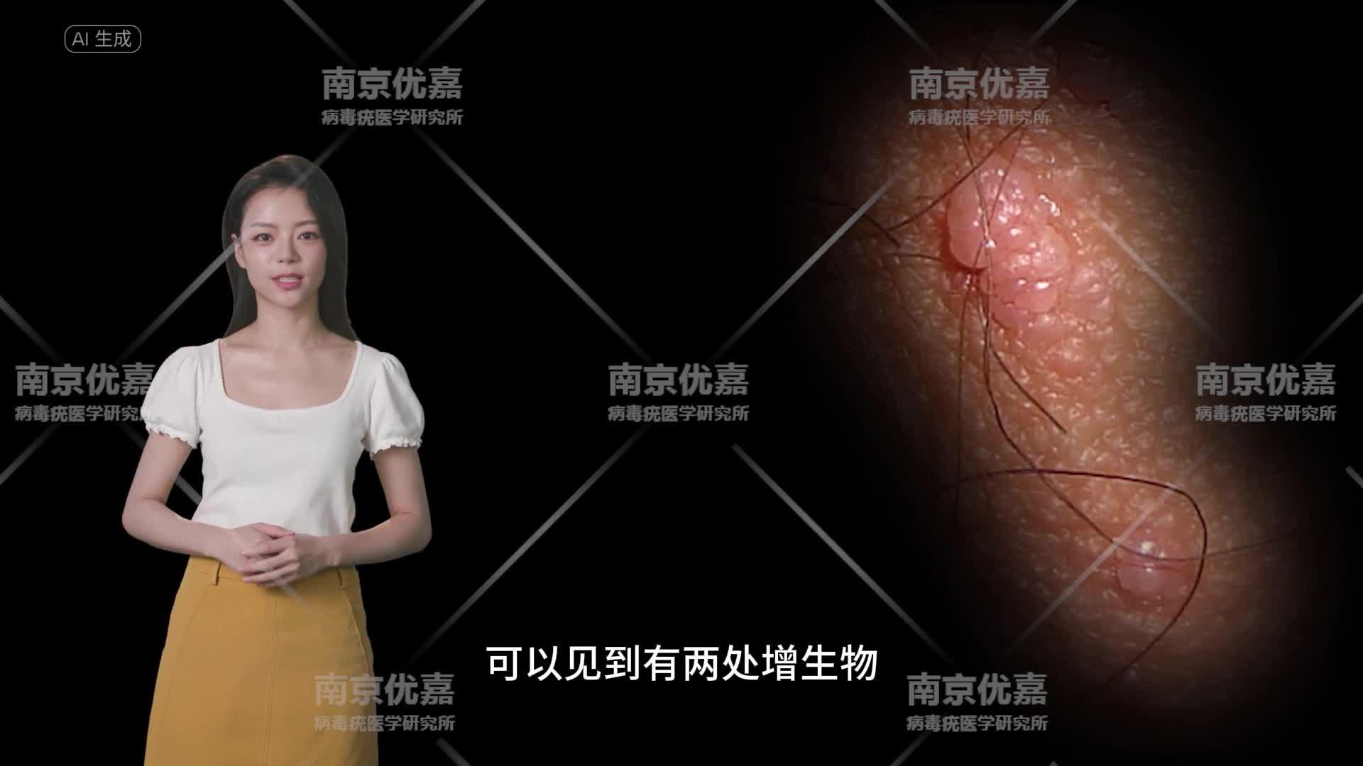 女性外阴尖锐湿疣初期症状图片