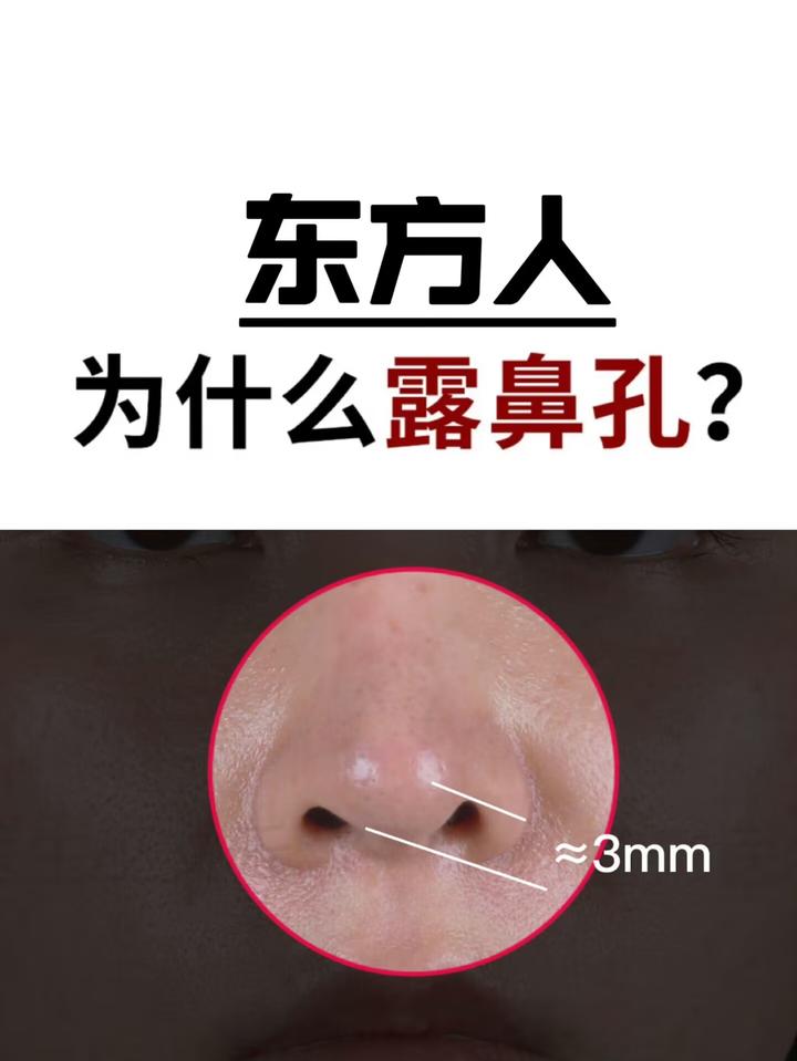 ‘朝天鼻’如何改善漏鼻孔？ 知乎