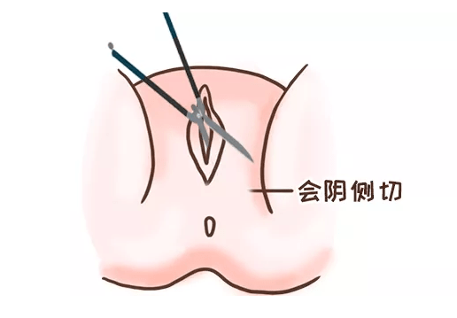 女人分娩侧切图片图片