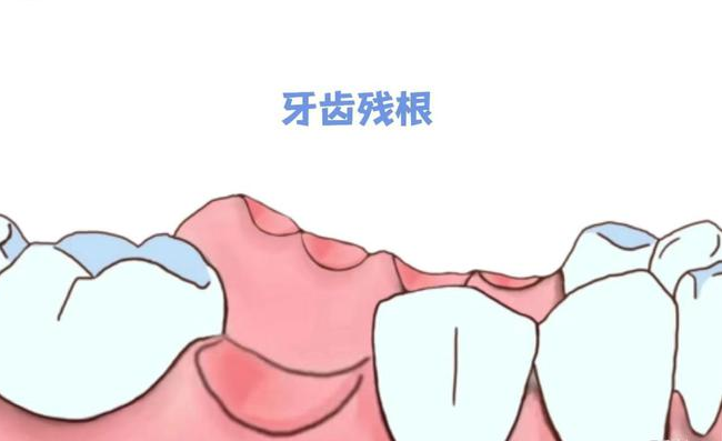 残根牙齿需要拔除吗?(上) - 知乎