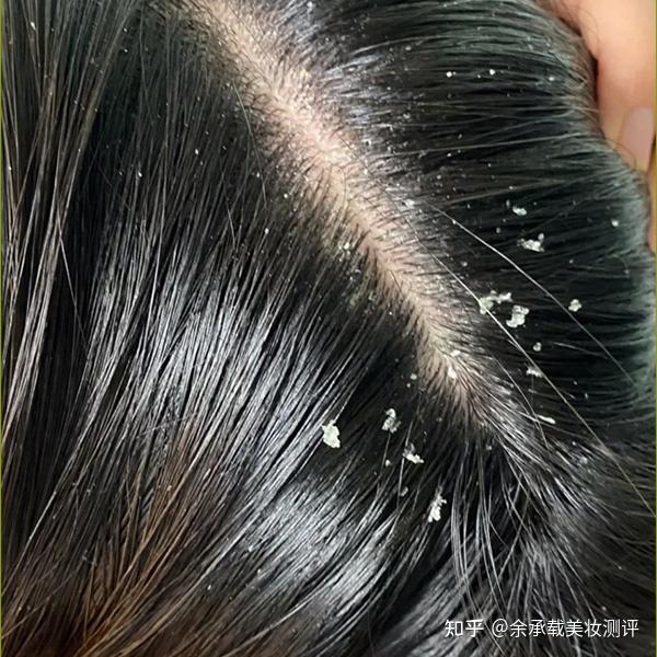 头皮发痒有头皮屑用什么洗发水好?女士去屑止痒控油洗发水排行 - 知乎