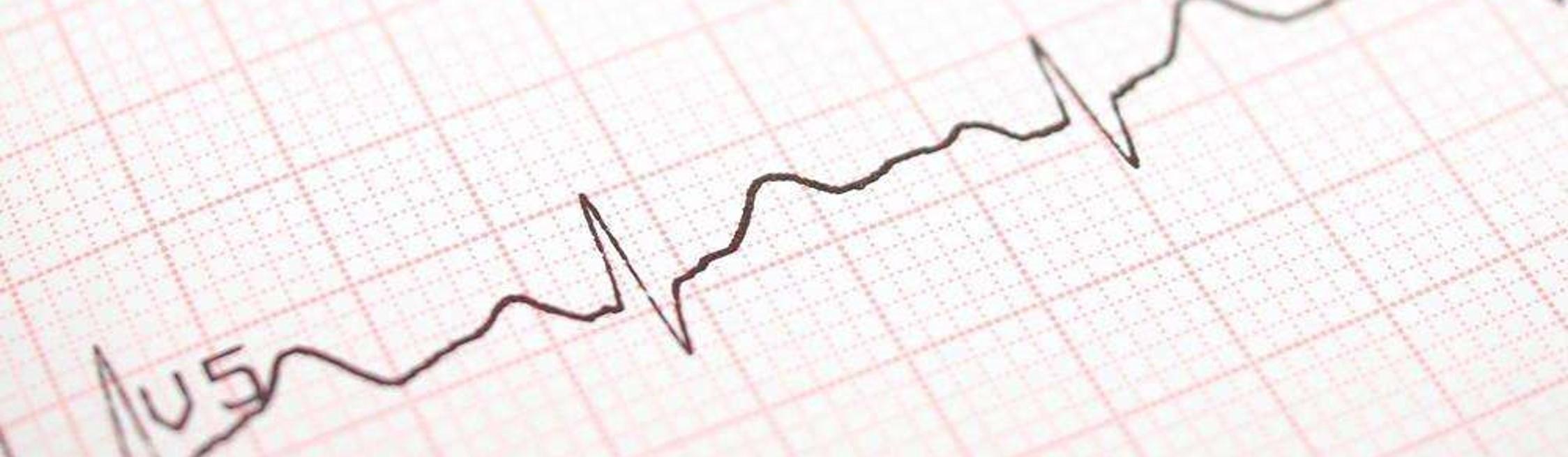 心电图ＱＲＳ波群电压的临床意义