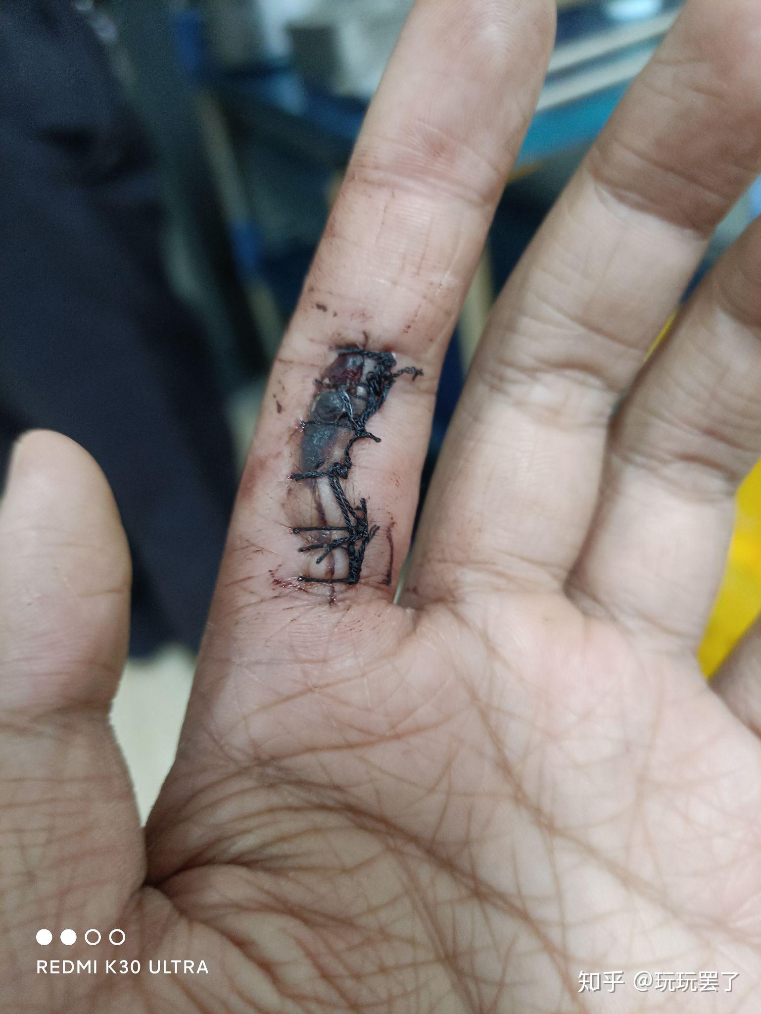 伤口拆线的时候疼吗