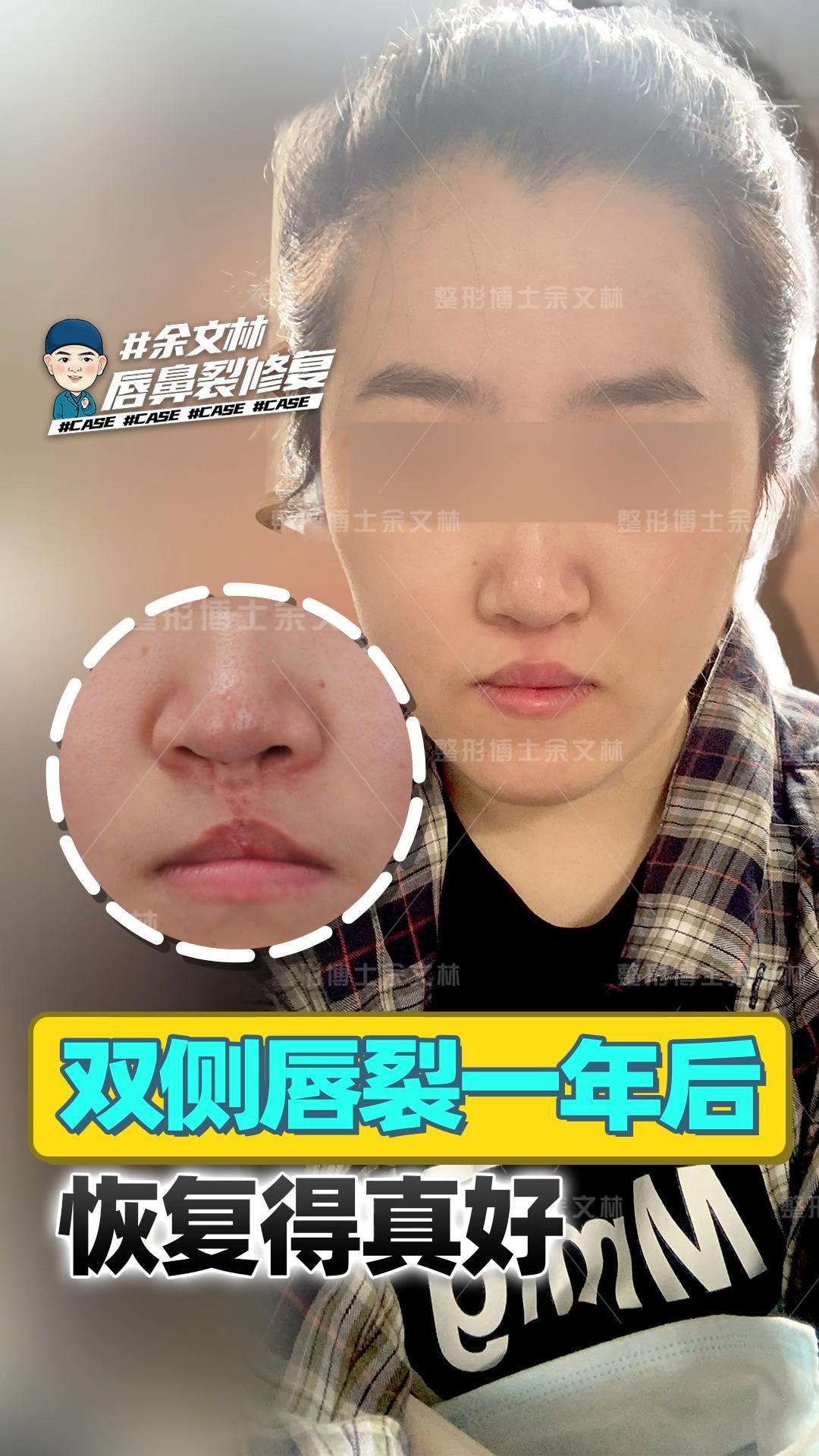 双侧唇裂修复一年后,恢复得真好!