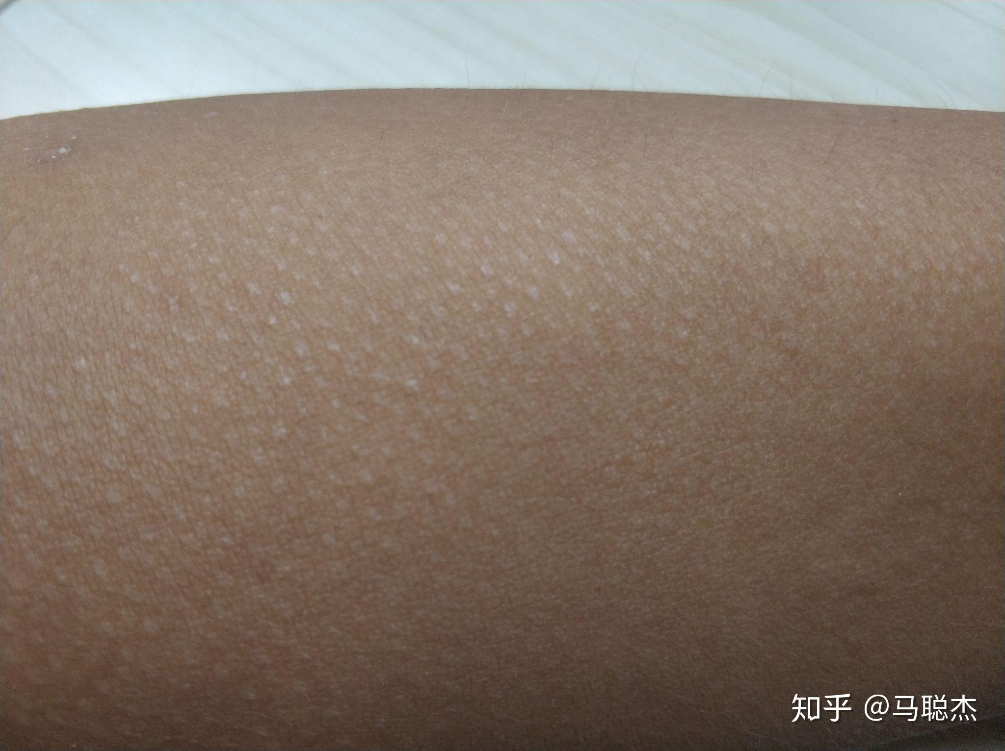 手臂,脖子,还有肚子的皮肤都有好多这样的像鸡皮疙瘩的白点,不痛不痒
