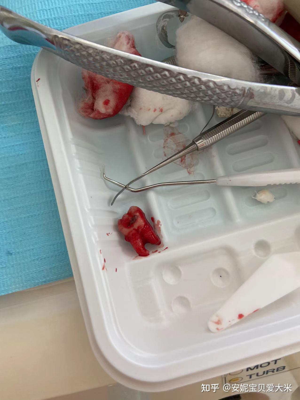 有一颗智齿一半长出来了一半在肉里,位置正,要拔吗? - 知乎