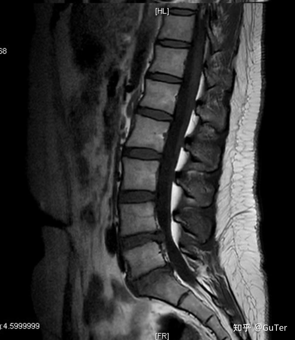 26岁腰椎间盘突出-腰突微创手术后记- 知乎