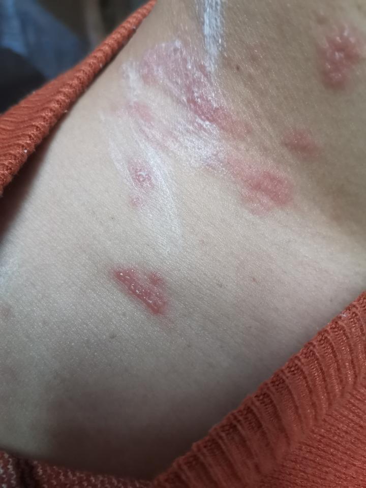 个人感染带状疱疹全过程(图片不适,谨慎打开)