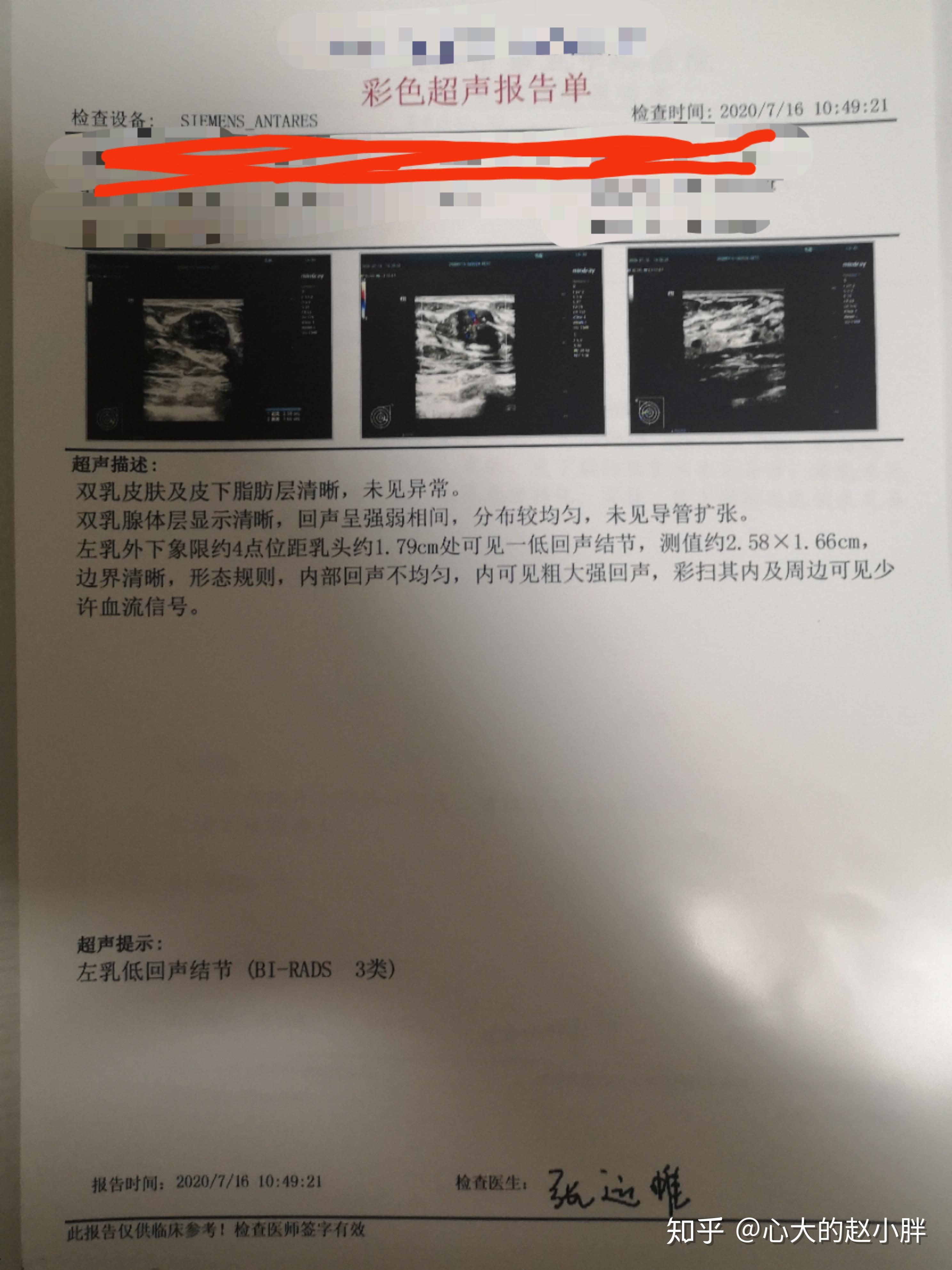 乳腺超声检查报告bi-rads 3级的女人们,你们几岁发现的,目前是良性的