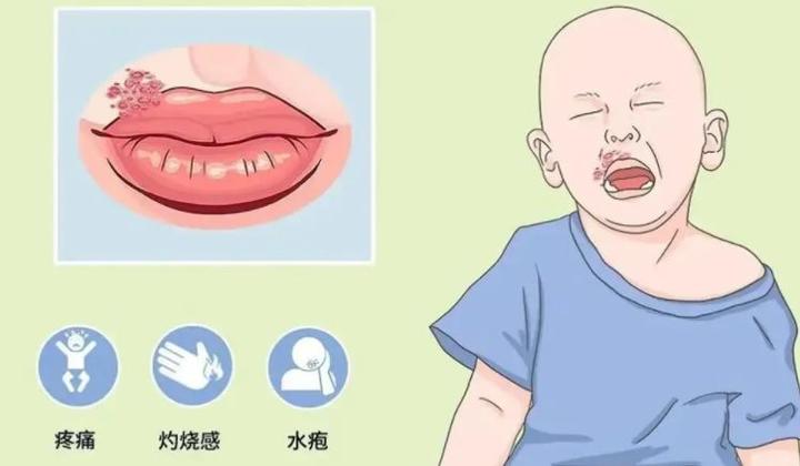 嘴里面疱疹是因为什么原因引起的 - 知乎