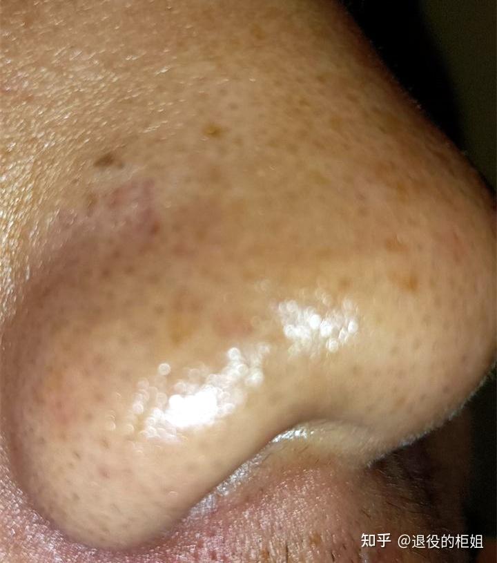 请仔细看下面这个,不仅毛孔里有小毛,毛孔周围还黑一圈:外源性黑色素