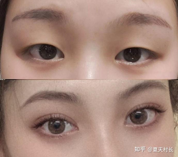 可以发一下你们开眼角的前后对比图吗