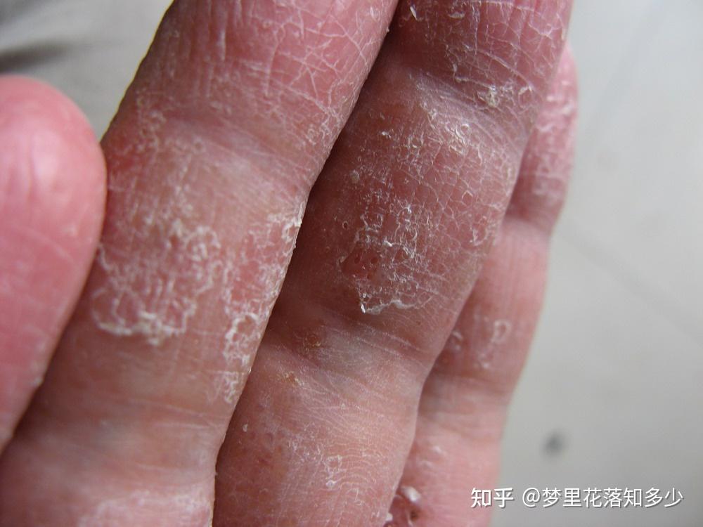 这是手癣初期症状么? - 知乎