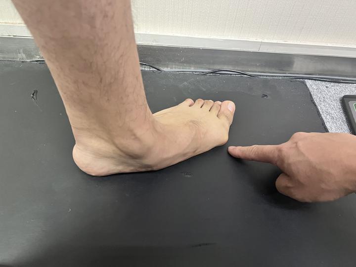 拇外翻症状与治疗：了解症状特征，选择合适治疗方式—我的门诊病例总结 - 知乎