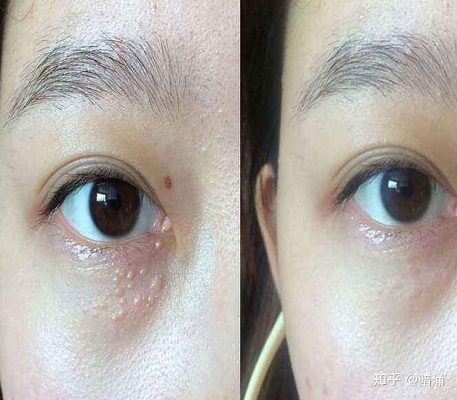 怎么消除眼睛上的脂肪粒