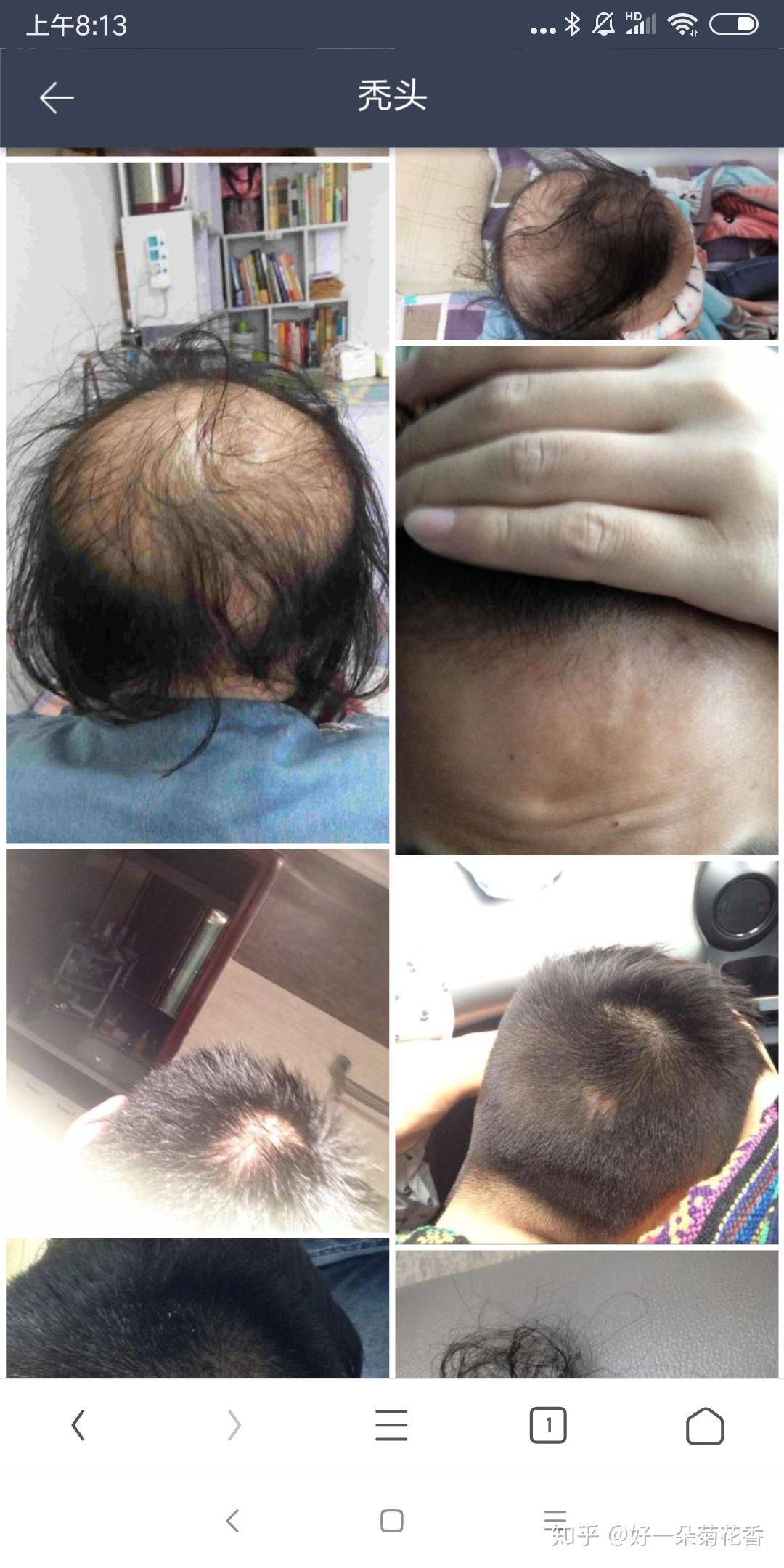 男士如何从秃头开始留长发