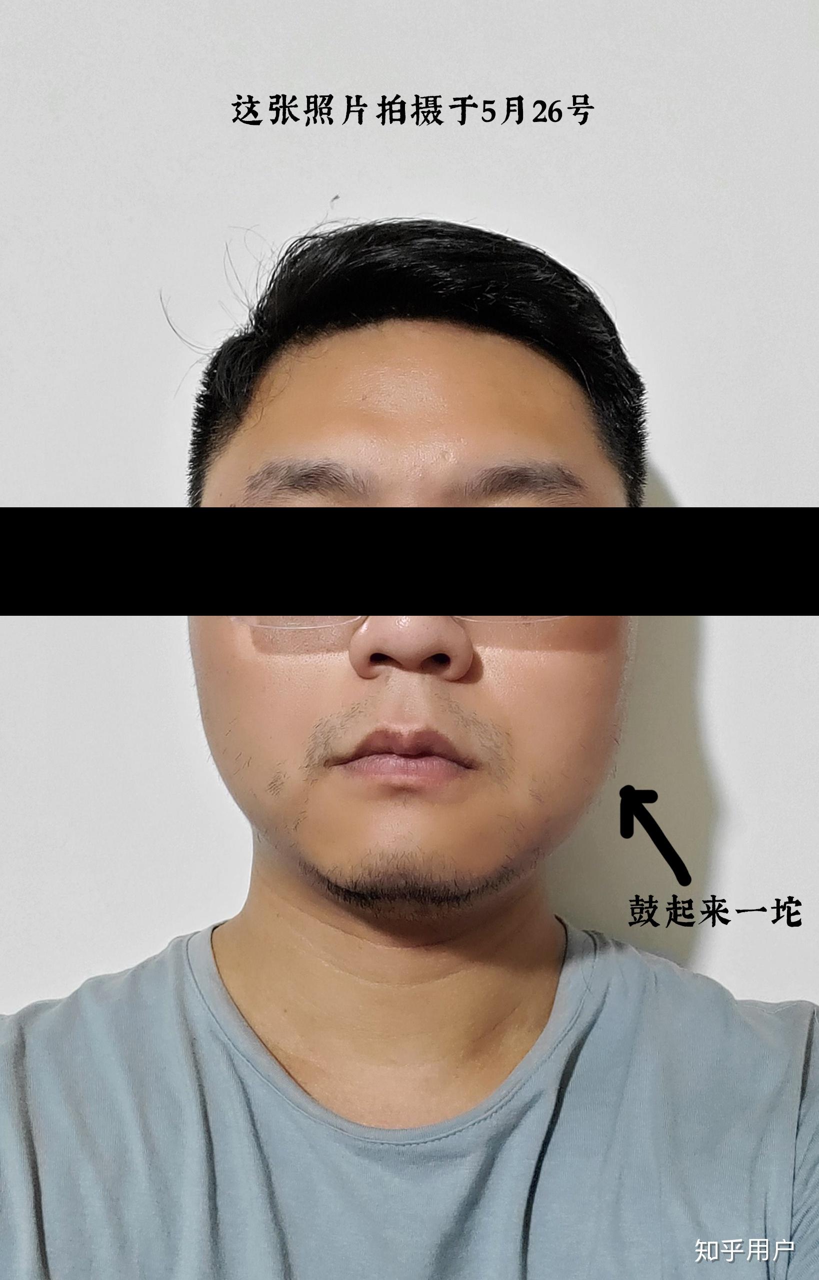 为什么都是经常咀嚼的那一边脸大,而我是咀嚼的那边脸小不咀嚼的那边