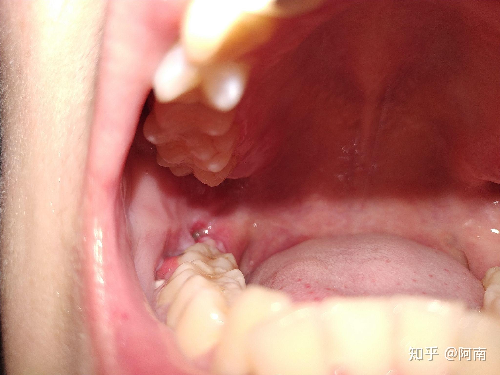 拔完智齿后超出一周的时间再去拆线可以吗