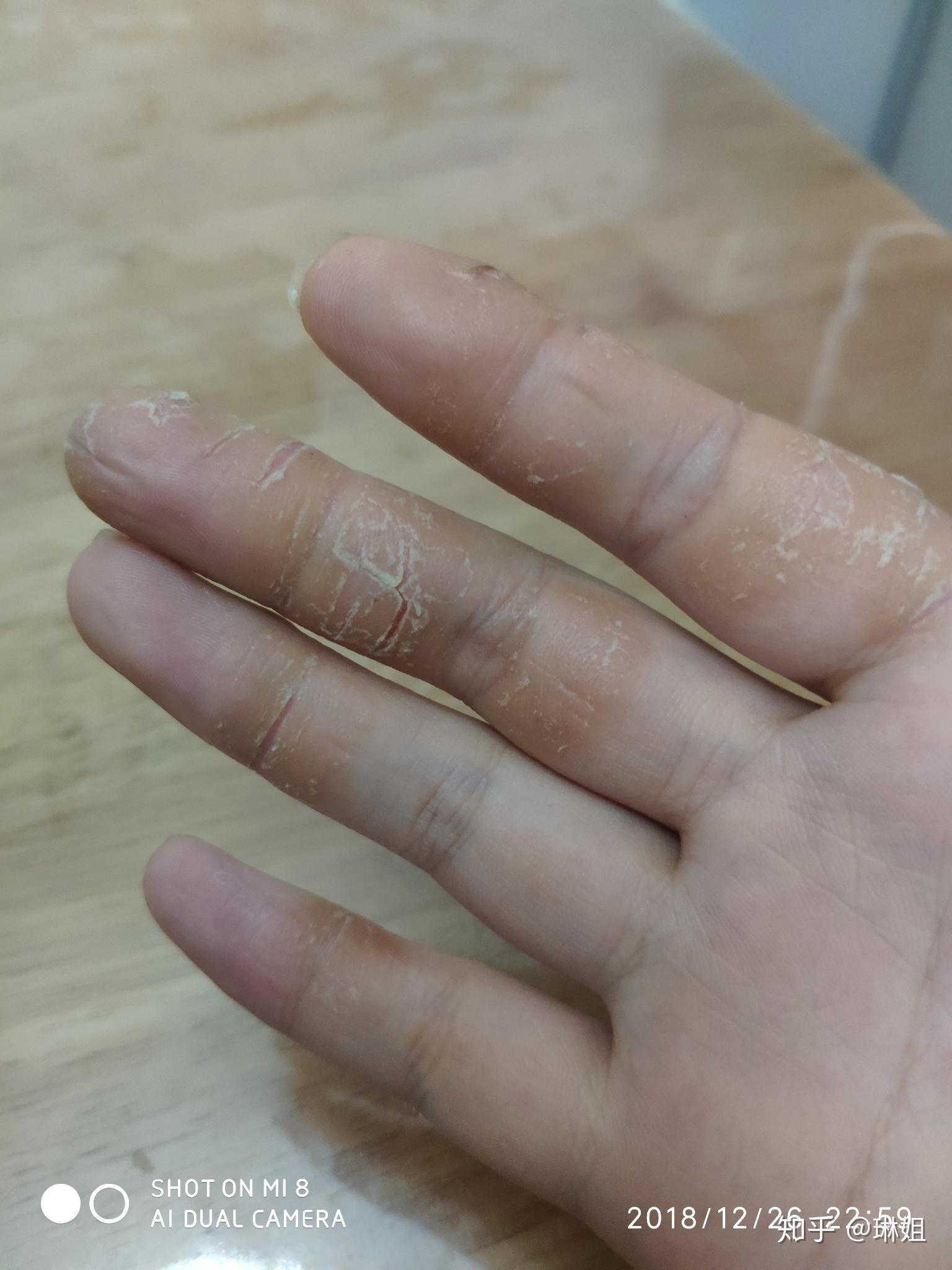 手上干裂型湿疹在哪里看比较好?
