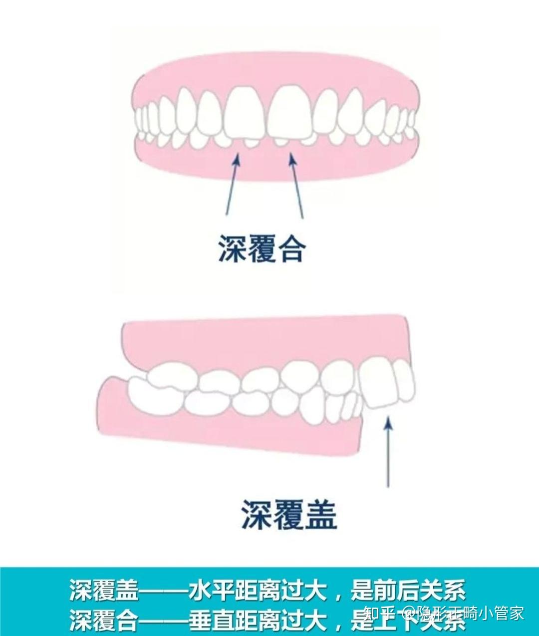 深覆合是什么?有什么危害? - 知乎