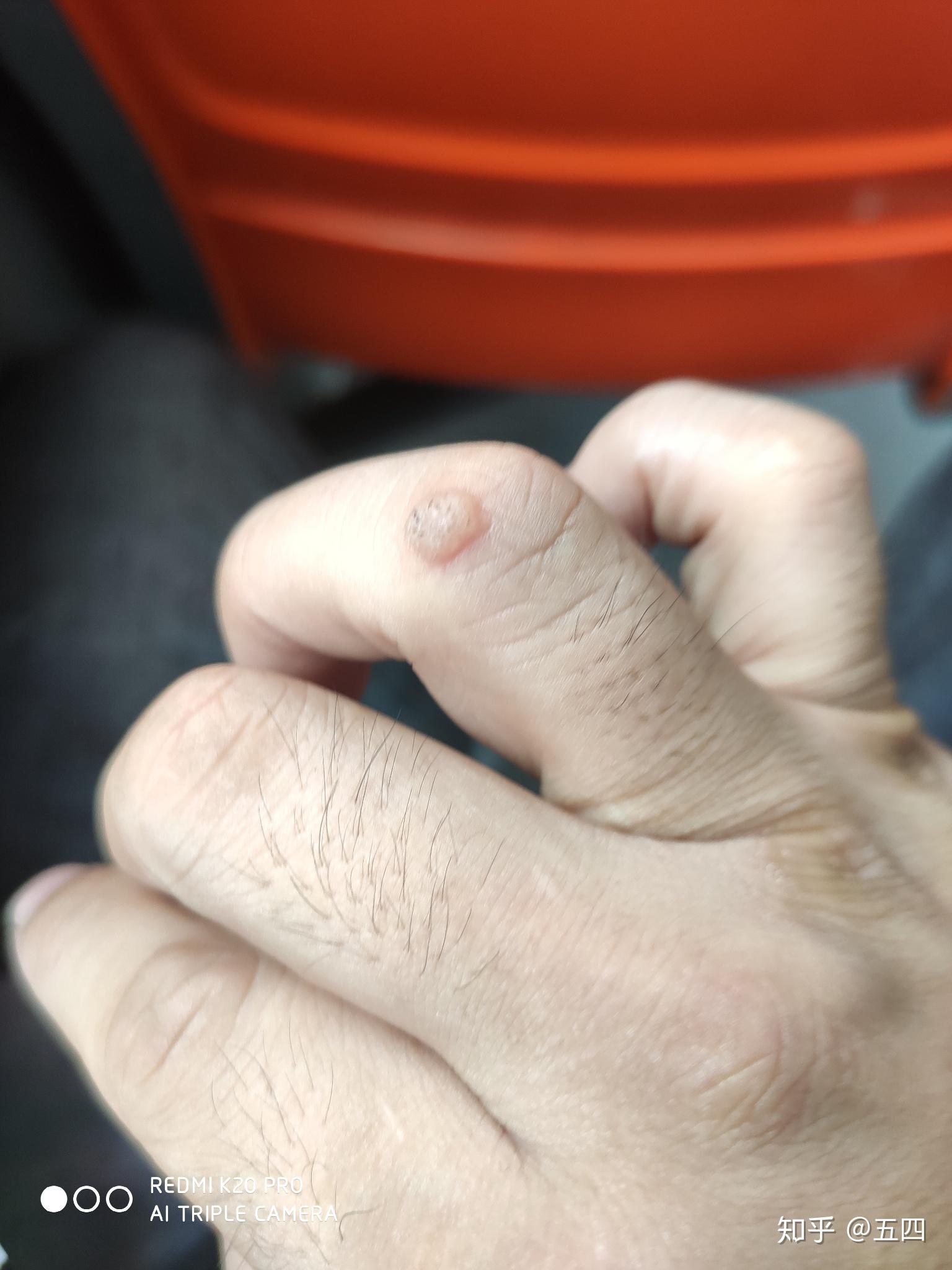 手指上长了个疙瘩表面有点硬,不疼也不痒,请问是什么东西,抠不掉?