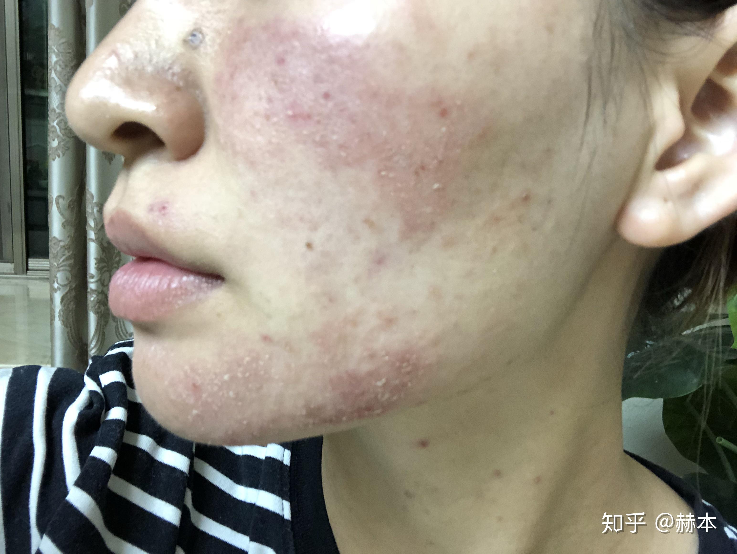 怎么看待五官漂亮但是皮肤差的女性? - 知乎