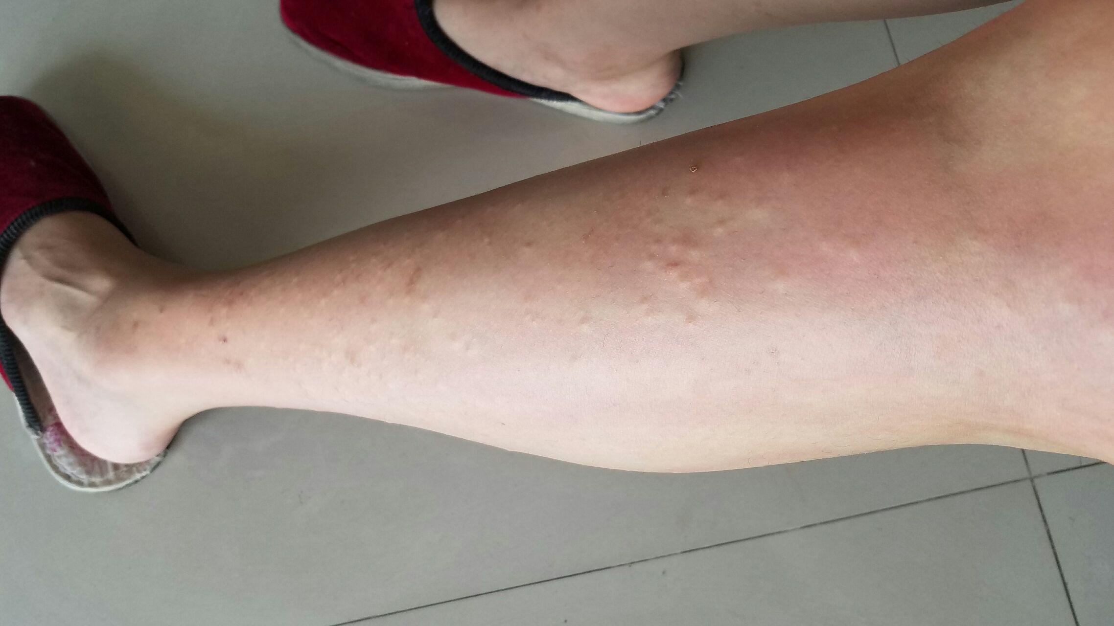 用过激光脱毛仪以后过敏一样有好多痒疙瘩怎么办