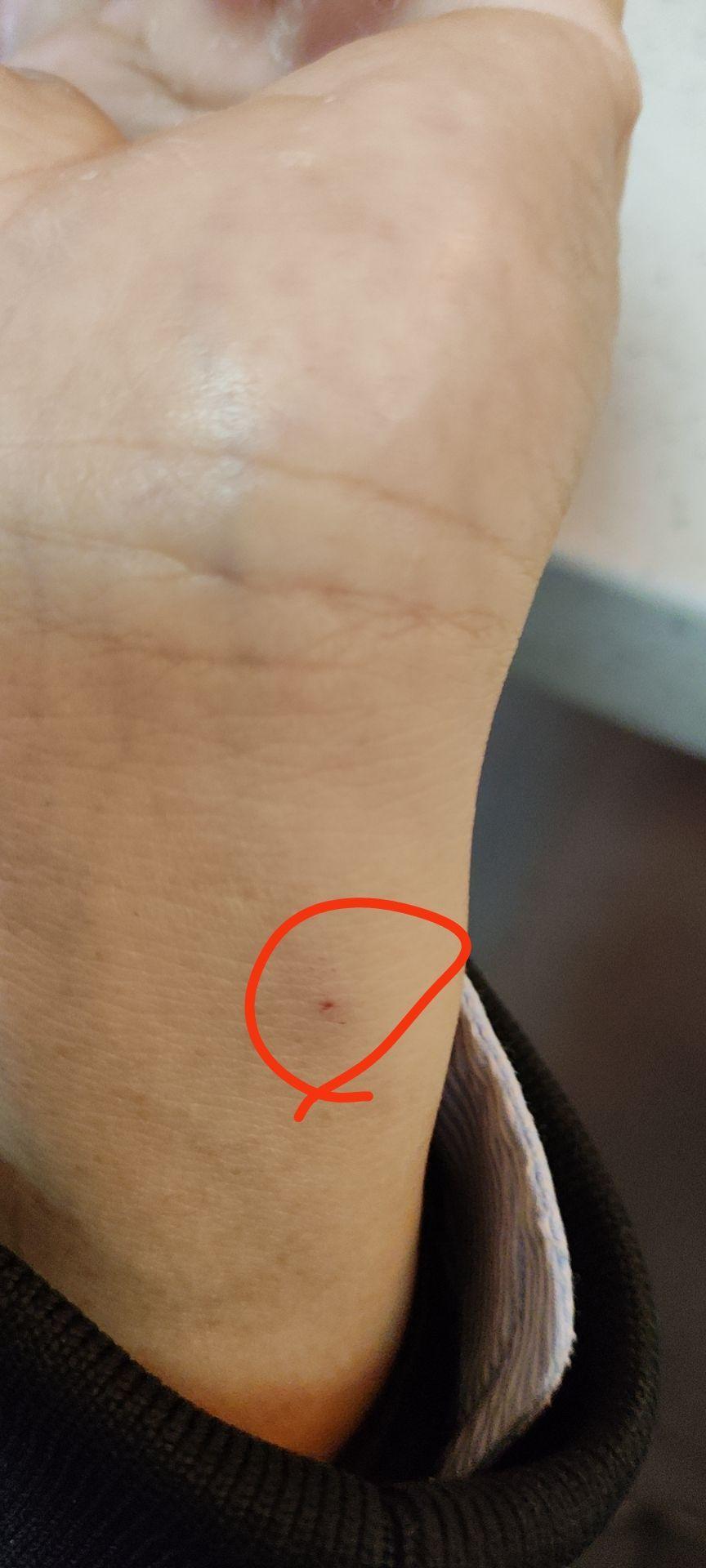 头孢过敏是什么症状和体验?