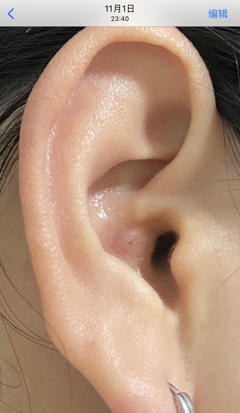 怎样对付外耳道的疖肿? - 知乎