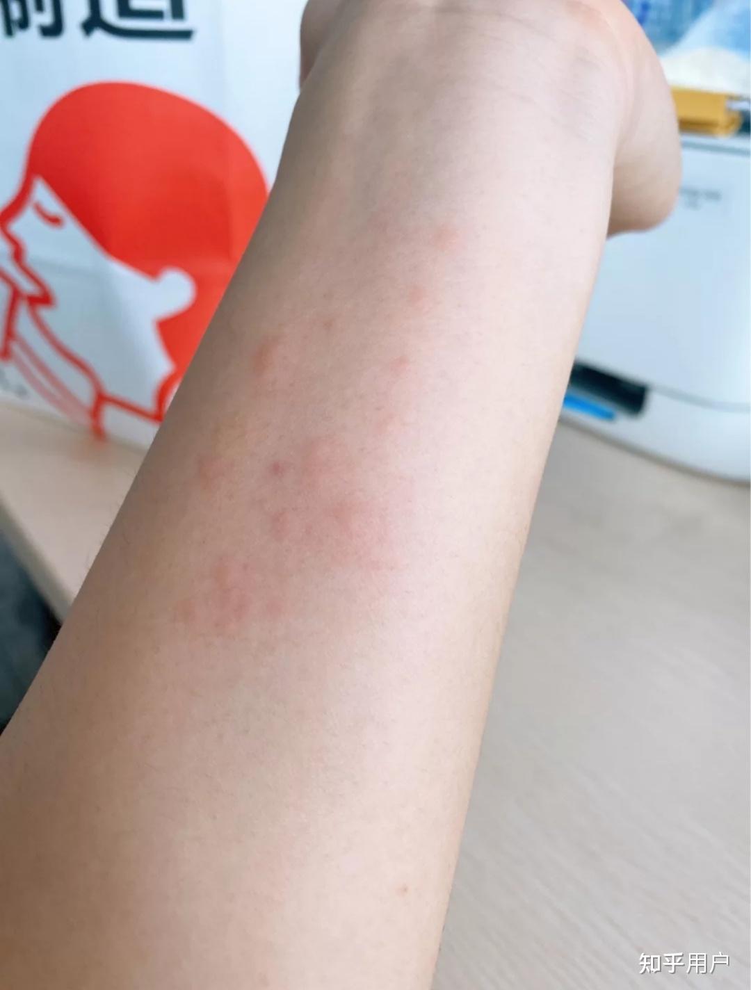 我之前试过很多种磨砂膏,不仅没效果,用完过敏就很难受.