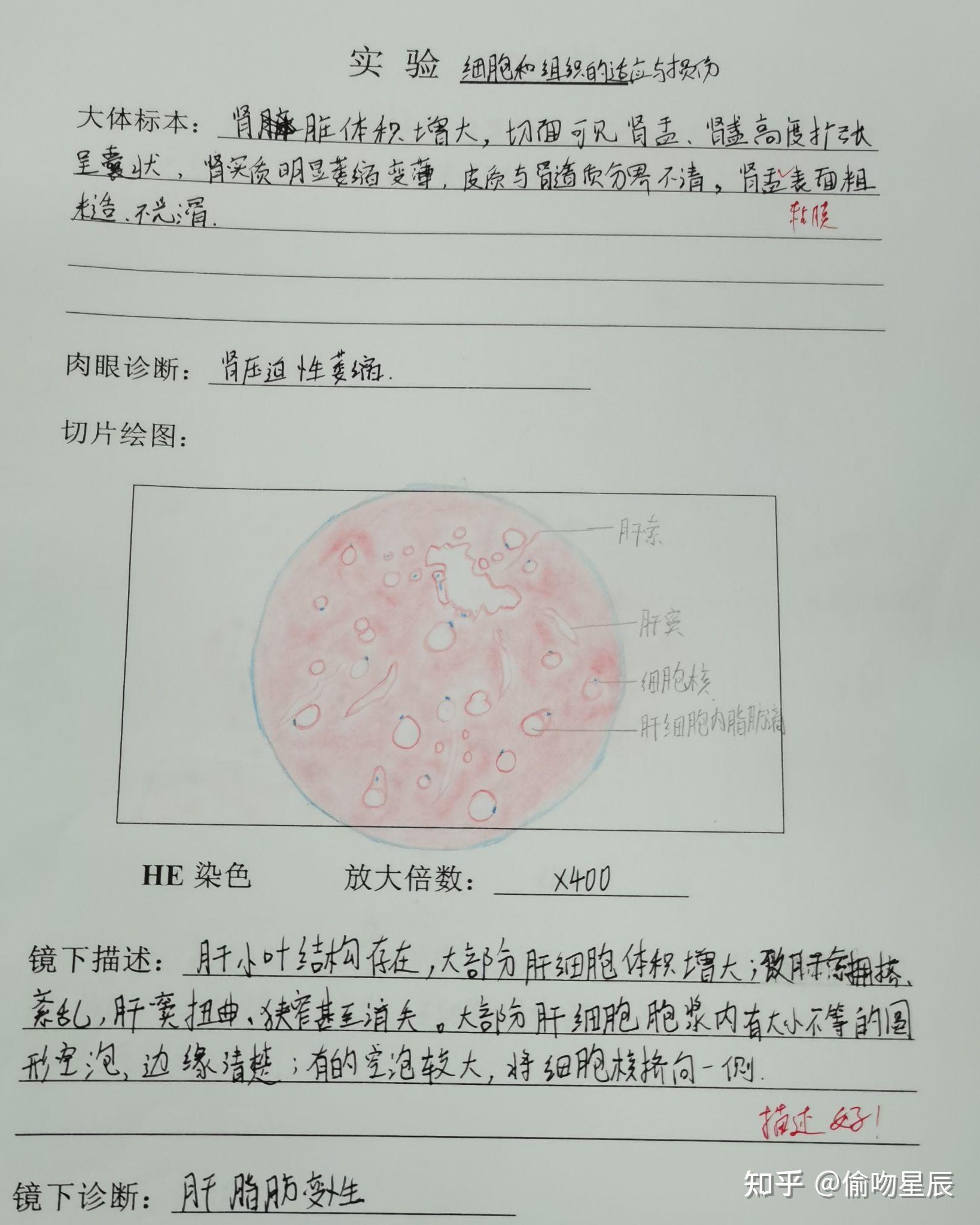 有没有人有病理的结肠腺癌红蓝铅笔手绘图啊? - 知乎