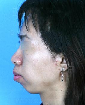 双颌前突长什么样?双颌前突症状表现有哪些?