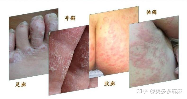 脚气会传染到手上吗? - 知乎