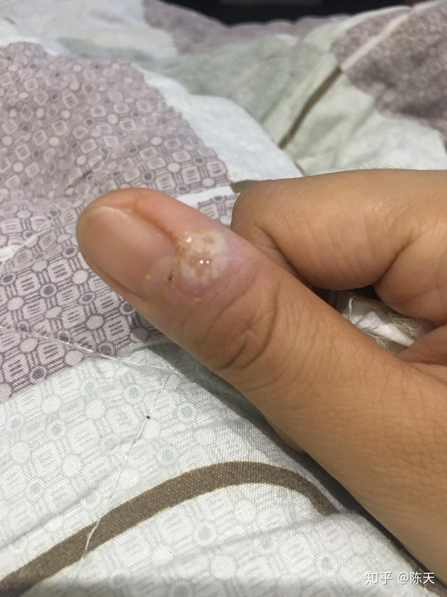 困扰了很多年的甲周疣,在右手的中指上,疣体已经占据了指甲的一半.