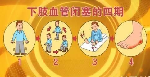 早期下肢动脉硬化如何治疗